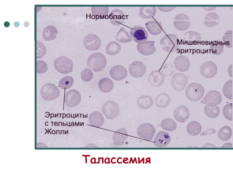 Нормобласты. Эритроцит с тельцем Жолли. Эритроциты с тельцами Жолли. Полихроматофильные эритроциты и тельца Жолли.