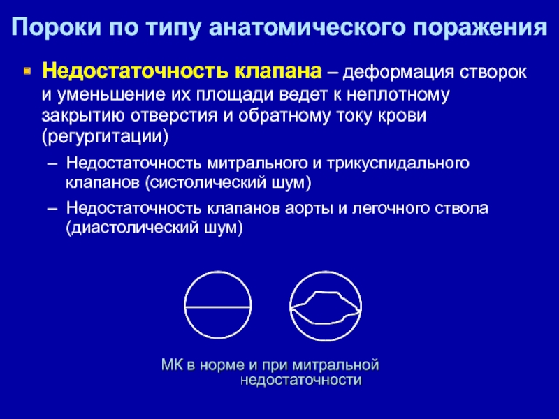 Изменение створок митрального клапана