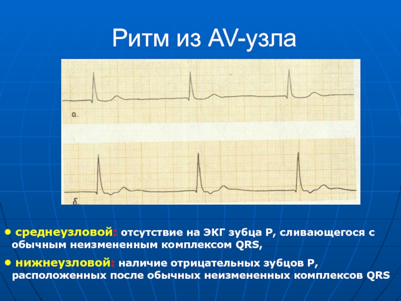 Ритм проводимости. Нижнеузловой ритм на ЭКГ. Среднеузловой ритм на ЭКГ. Ритм из АВ узла на ЭКГ. Верхнеузловой ритм на ЭКГ.