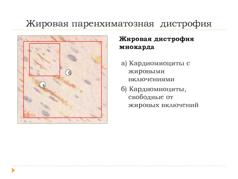 Жировая дистрофия презентация