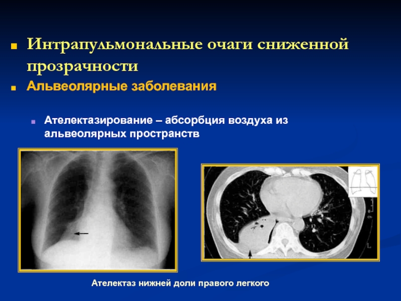 Ателектаз легкого кт картина