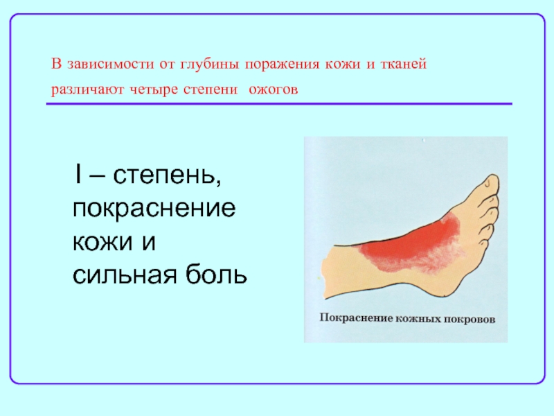 Степени ожогов кожи. По глубине поражения (4 степени) ожогов.