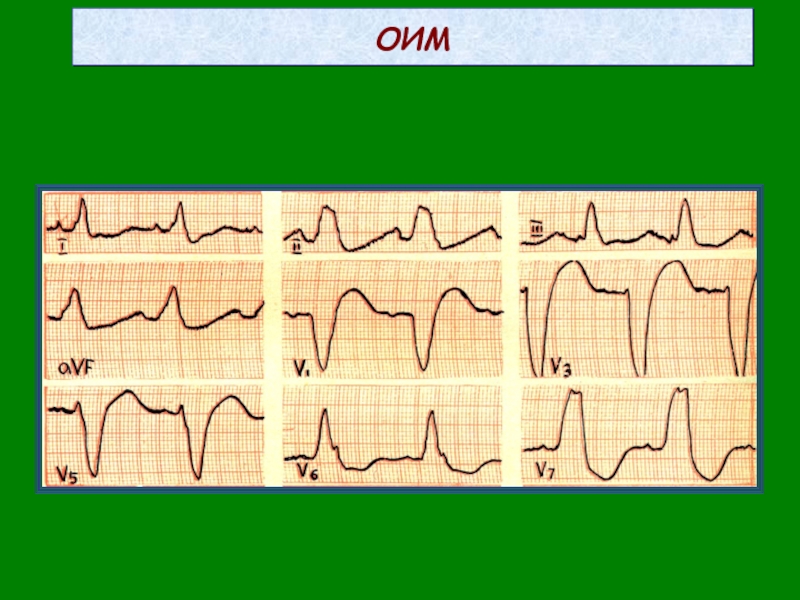Признаки инфаркта на ЭКГ. 4c Тип ОИМ.