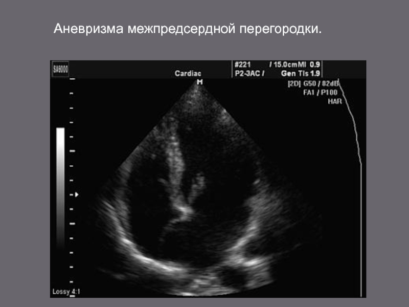 Дхлж диагноз. Аневризма левого желудочка на УЗИ сердца. Аневризма МПП Эхо. Дополнительная хорда в сердце на УЗИ. Хорда в левом желудочке на УЗИ.