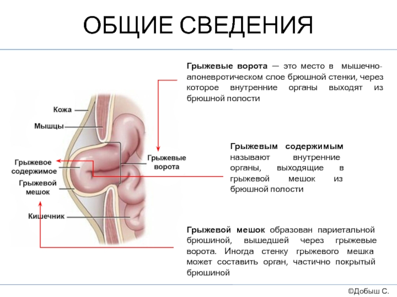 Грыжевой мешок