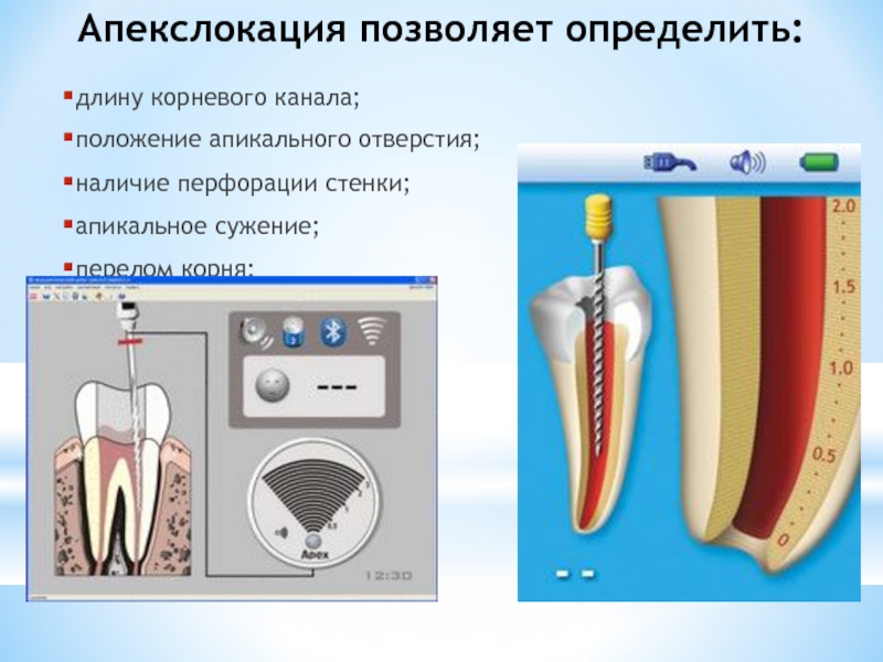 Определение корневых каналов. Как определить длину корневого канала. Апекслокация корневого канала зуба. Определение длины корневого канала аппараты. Методы определения длины корневого канала.