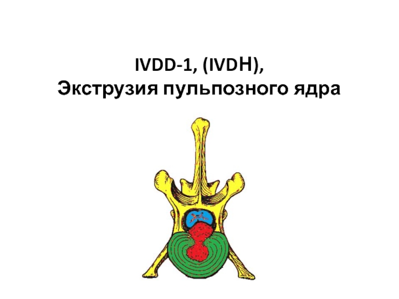IVDD-1, (IVDН), Экструзия пульпозного ядра