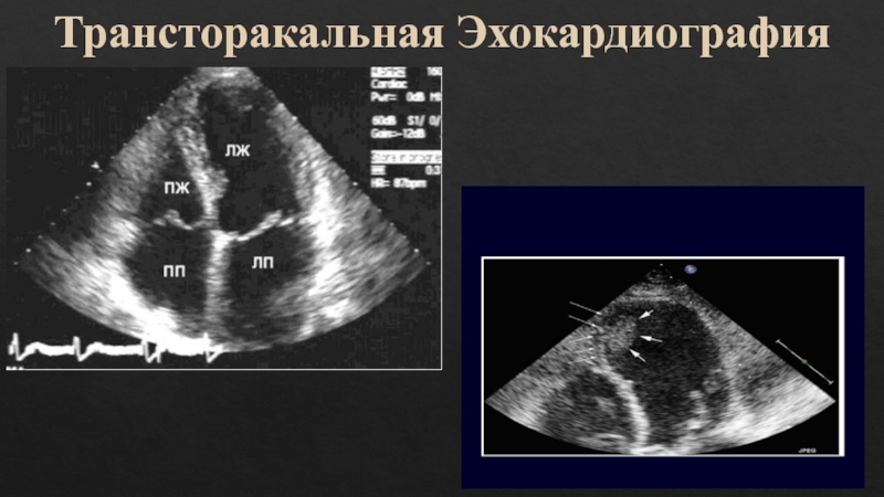 Эхокардиография что это. Трансторакальная ЭХОКГ методика. Трансторакальнаяое Эхо-кг показания. УЗИ сердца (трансторакальная эхокардиография. УЗИ сердца трансторакальное что это.