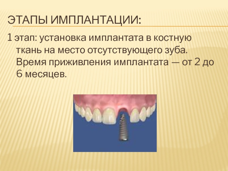 Презентация по имплантации