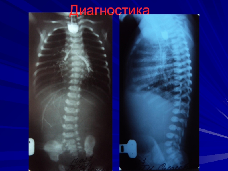 Атрезия пищевода у детей презентация