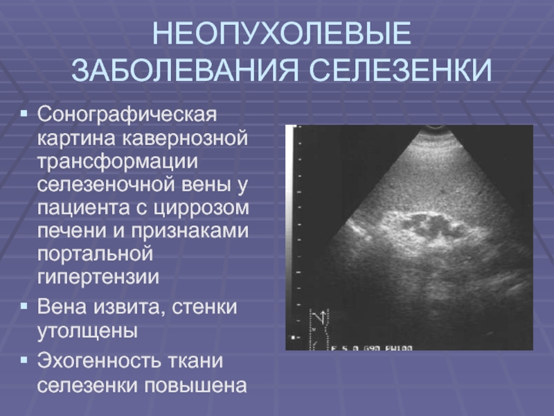 Портальная гипертензия узи картина