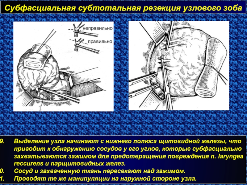 Что такое резекция сальника