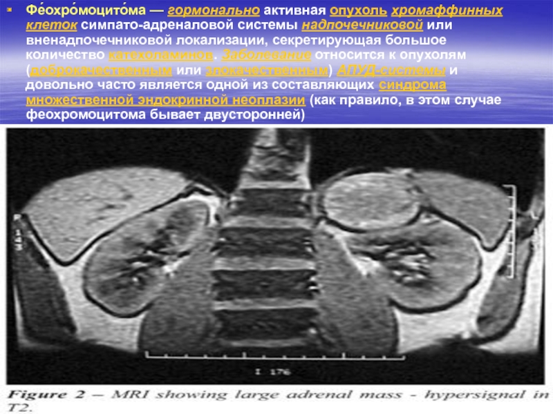 Феохромоцитома фото больных