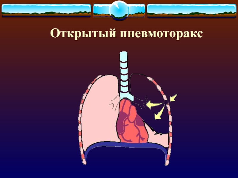 Открытый пневмоторакс. 2) Открытый пневмоторакс. Открытый пневмоторакс механизм. Открытый пневмоторакс хирургия. Клинические проявления открытого пневмоторакса.