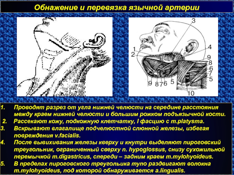 Треугольник кало топографическая анатомия. Перевязка язычной артерии. Обнажение и перевязка язычной артерии. Операция перевязки язычной артерии. Перевязка подъязычной артерии.