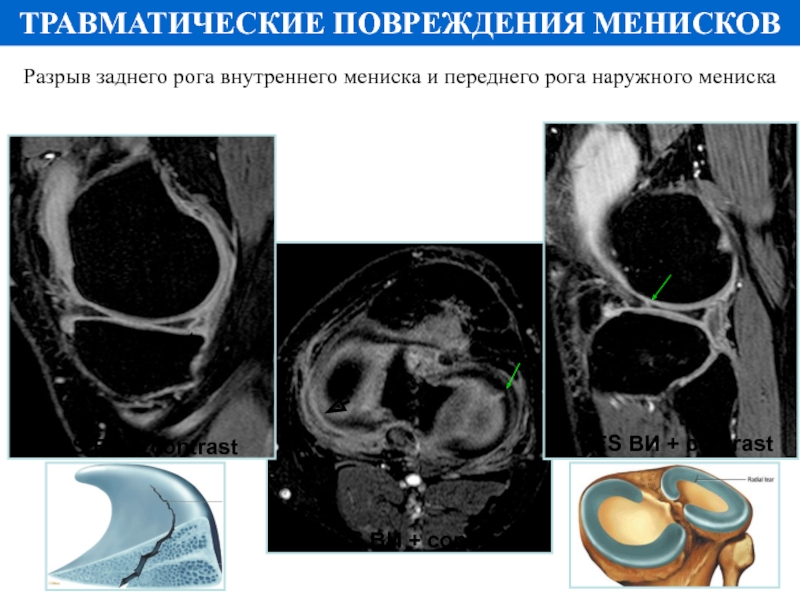 Мр картина повреждения внутреннего мениска 3а степени по stoller