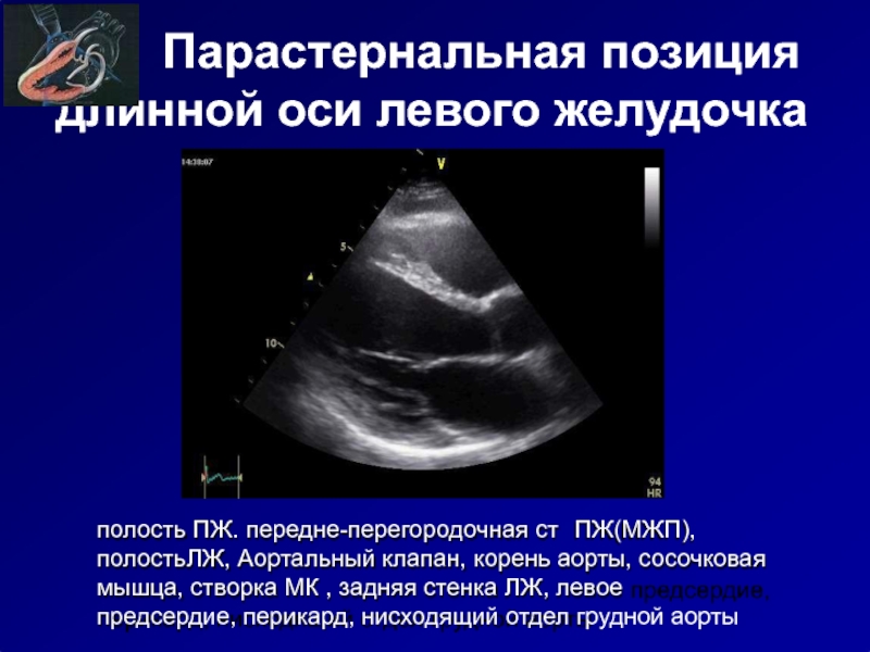 Длинная ось. Створки аортального клапана по короткой оси. Парастернальная позиция в ЭХОКГ. Эхокардиография левая парастернальная позиция длинная ось. Парастернальная позиция длинная ось левого желудочка.