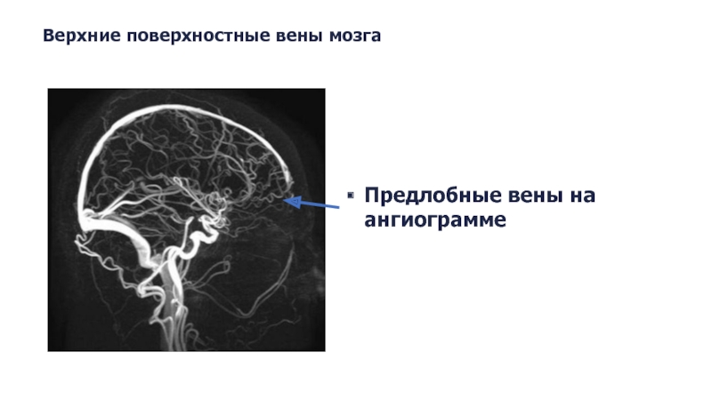 Верхние вены мозга. Поверхностные вены мозга. Поверхностные вены теменной доли. Нормальная ангиограмма мозга a1.