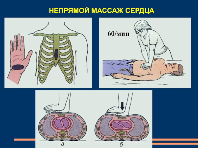 Непрямой массаж сердца презентация