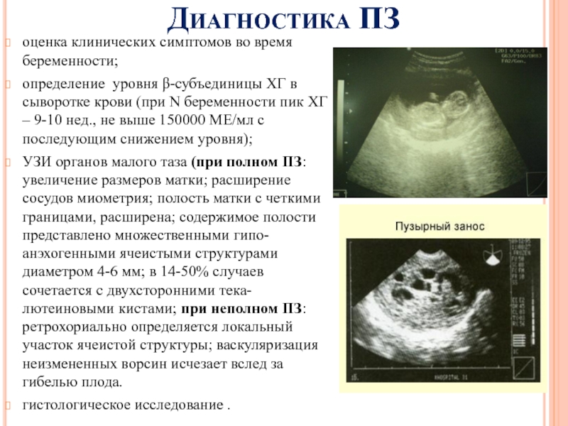 Диагностика ПЗоценка клинических симптомов во время беременности;определение уровня β-субъединицы ХГ в сыворотке крови (при N беременности пик