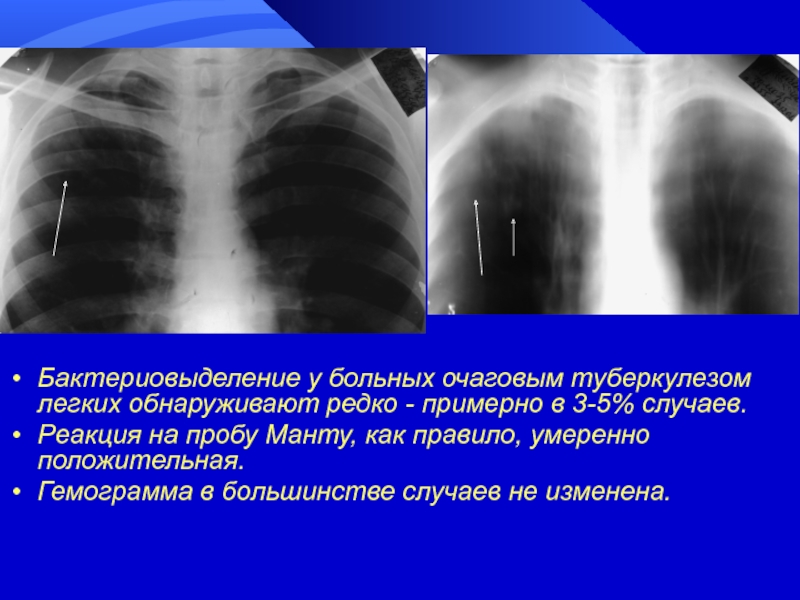 Презентация очаговый туберкулез легких