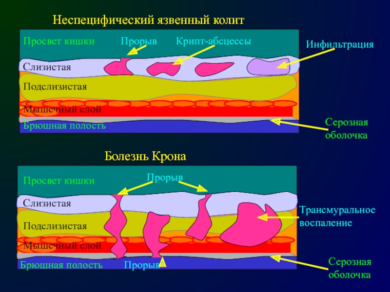 Патогенез болезни крона схема