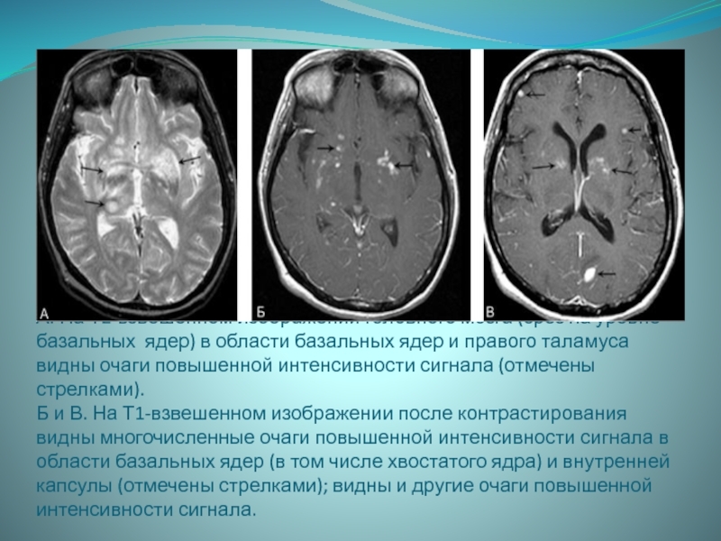 Постишемические изменения мозга. Базальные ядра мозга мрт. Таламус на акт головного мозга. Кистозные изменения головного мозга. Обызвествление базальных ядер.