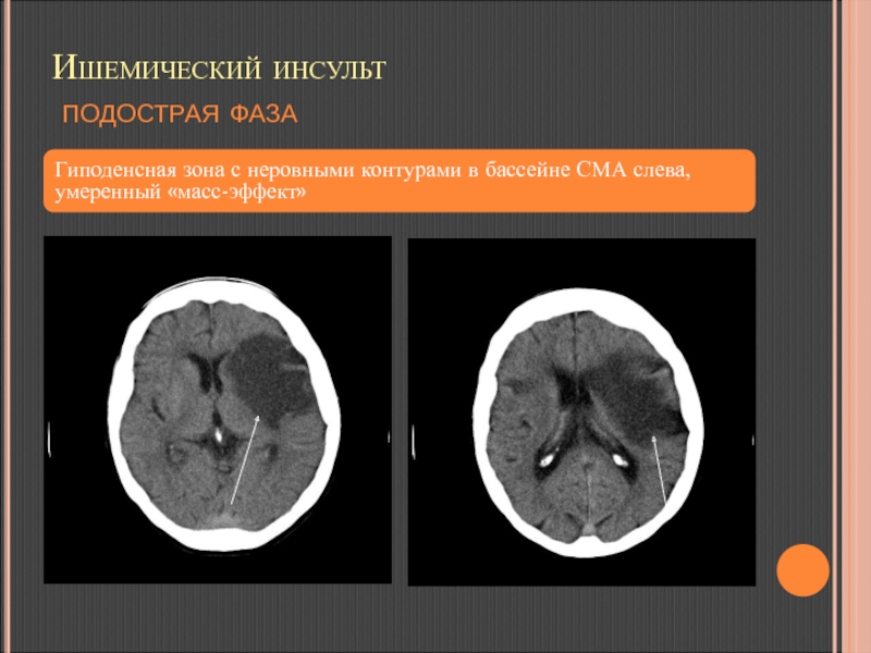 Инсульт сма. Ишемический инсульт на кт головного мозга. Ишемический инсульт гиподенсная зона. Подострый ишемический инсульт на кт. Подострый геморрагический инсульт кт.