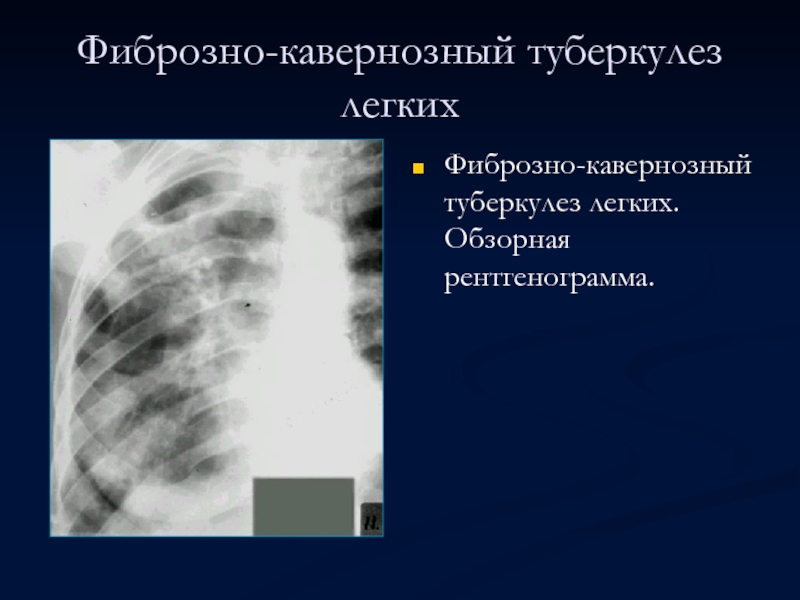 Фиброзно-кавернозный туберкулез легких Фиброзно-кавернозный туберкулез легких. Обзорная рентгенограмма.