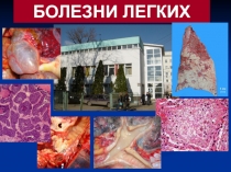 болезни легких 