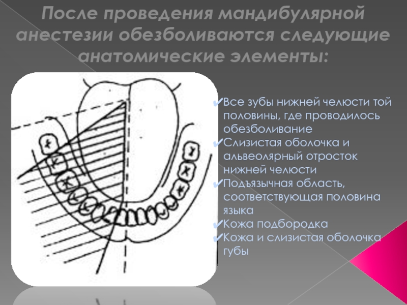 Мандибулярная анестезия в стоматологии схема проведения видео