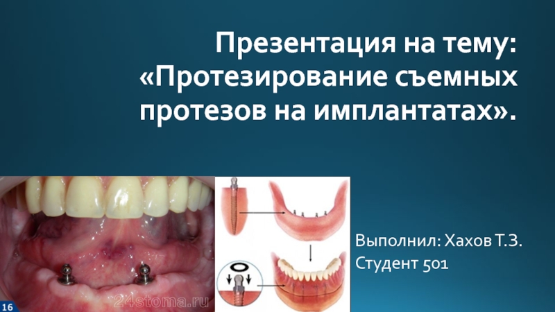 Протезирование съемных протезов на имплантатах