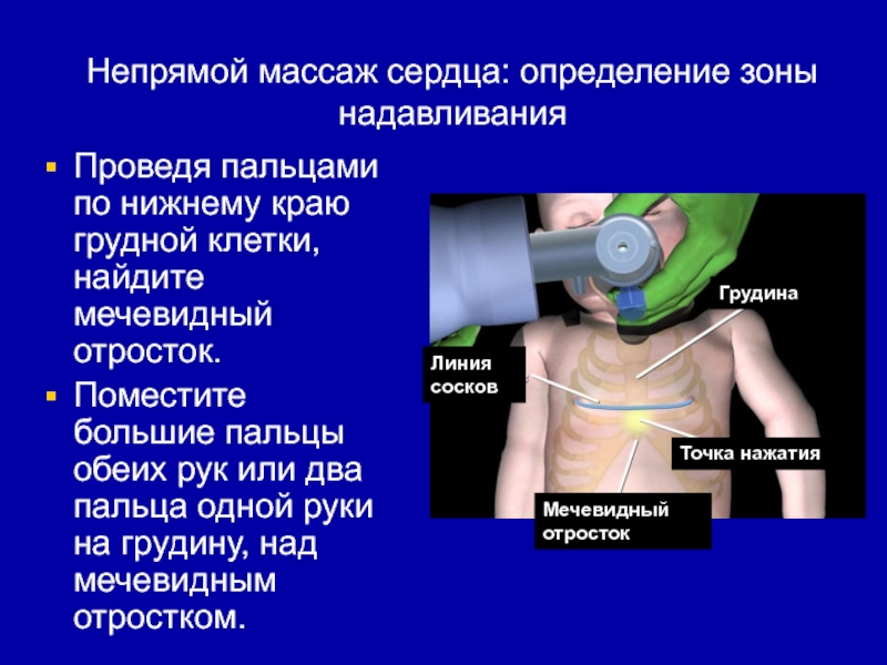 Мечевидный отросток грудины. Непрямой массаж сердца у детей. Алгоритм проведения непрямого массажа сердца. У детей до года непрямой массаж сердца проводят. Проведение непрямого массажа сердца детям.