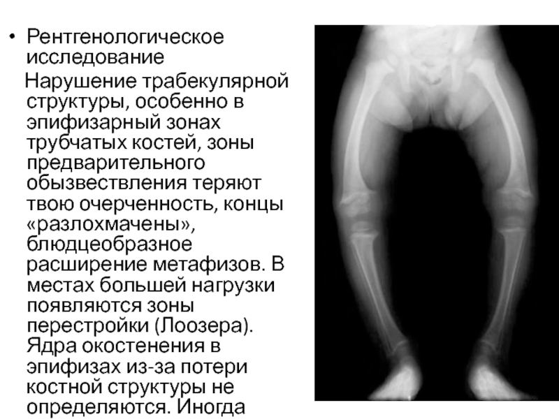 Для начального периода рахита характерна следующая рентгенологическая картина