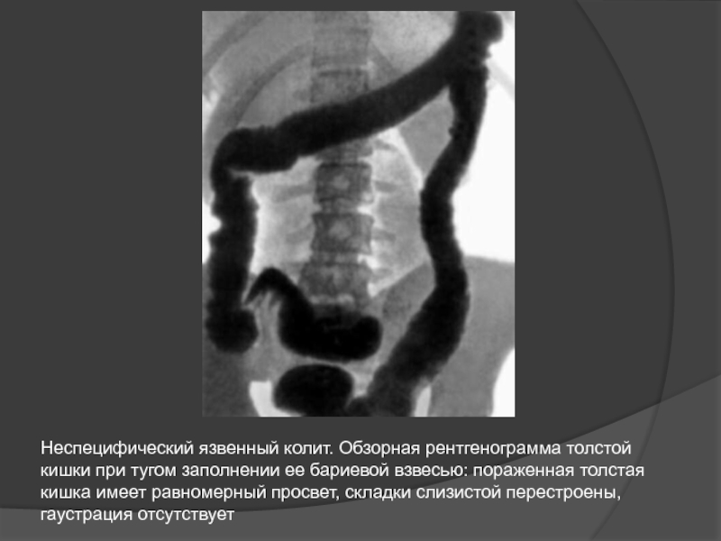 Картина колоноскопии при няк