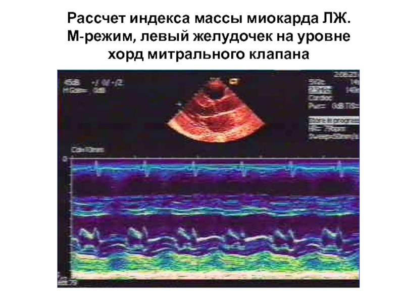 Дисфункция хорд митрального клапана