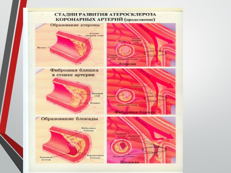 Атеросклероз анатомия. Схема развития атеросклероза. Стадии развития атеросклеротической бляшки. Атеросклероз стадии и степени.
