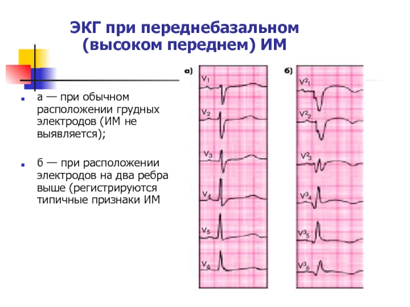 Инфаркт миокарда пропедевтика внутренних болезней презентация