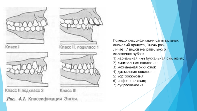 Мезиальная окклюзия презентация ортодонтия