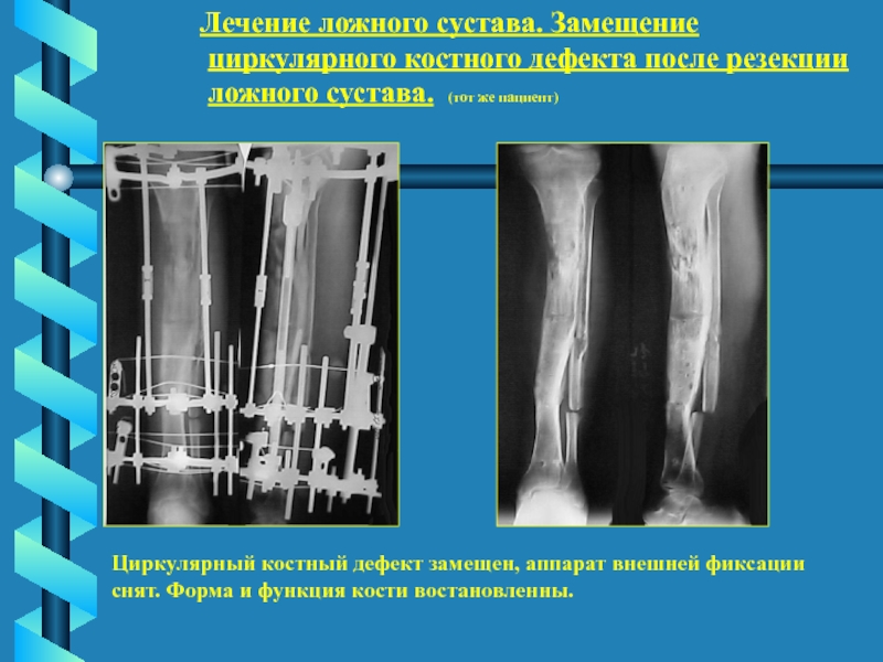 Ложный сустав рисунок