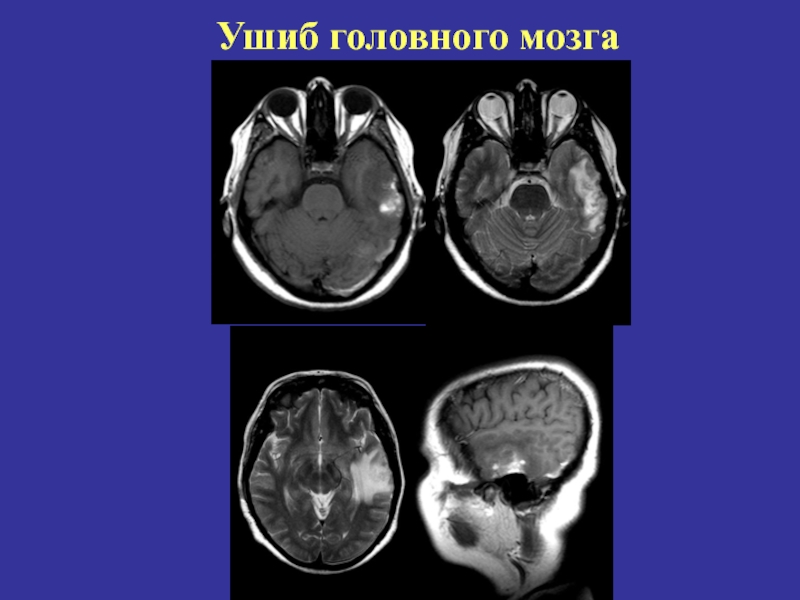 Ушиб головного мозга картинки