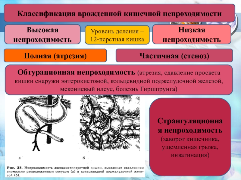 Врожденная кишечная непроходимость презентация