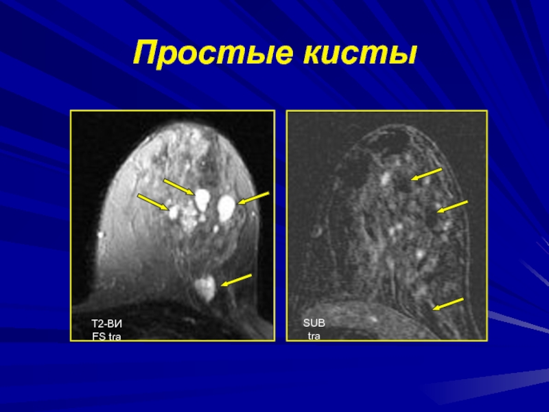 Лучевая диагностика заболеваний молочных желез презентация