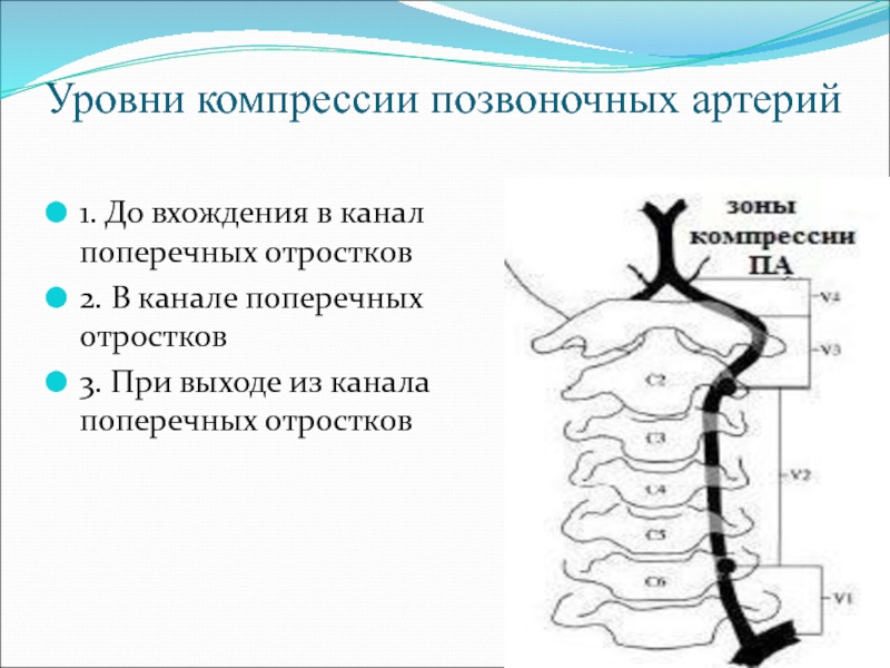 Сегменты позвоночной артерии схема