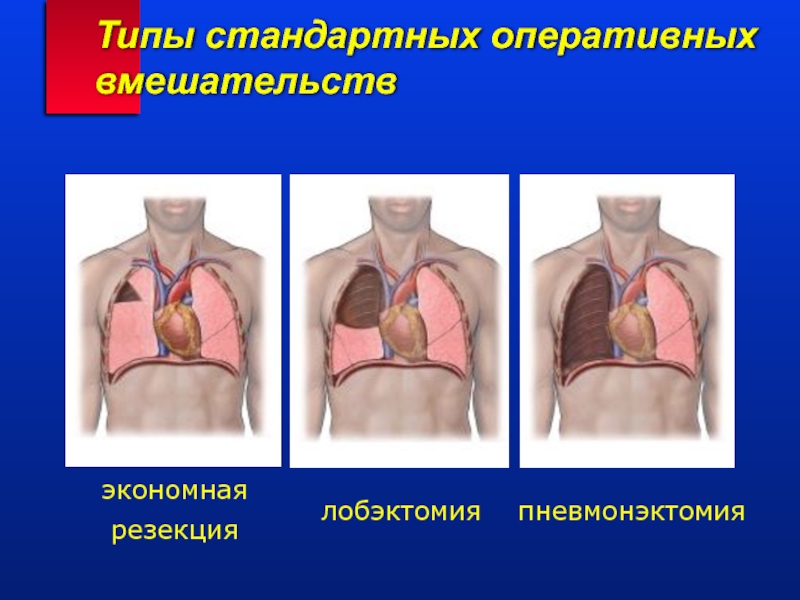 Операция На Легких Фото