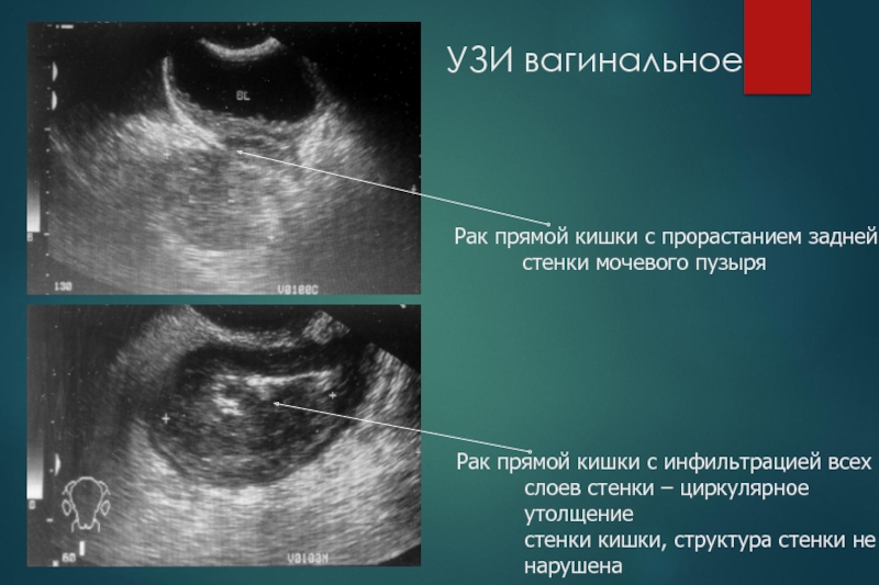 Рак на узи. Внутривагинальное УЗИ. Образование кишечника на УЗИ. Образование сигмовидной кишки на УЗИ.