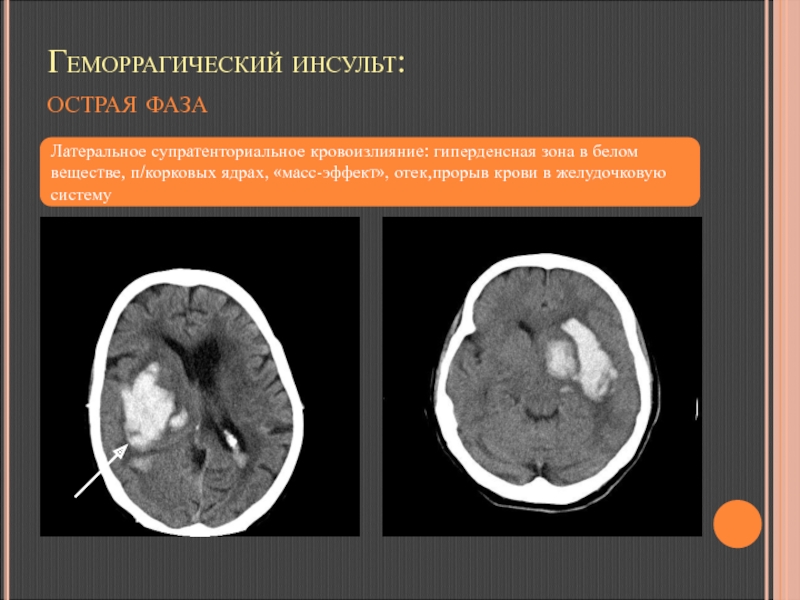 Геморрагический инсульт на кт фото