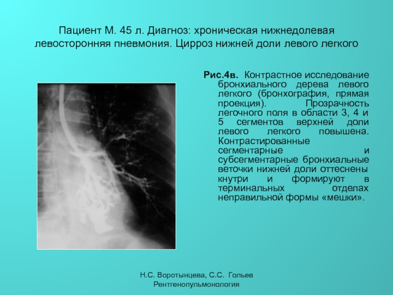 Левосторонняя пневмония