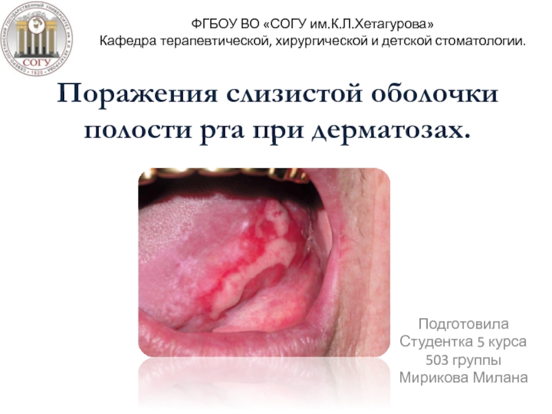 Поражения слизистой оболочки полости рта при дерматозах