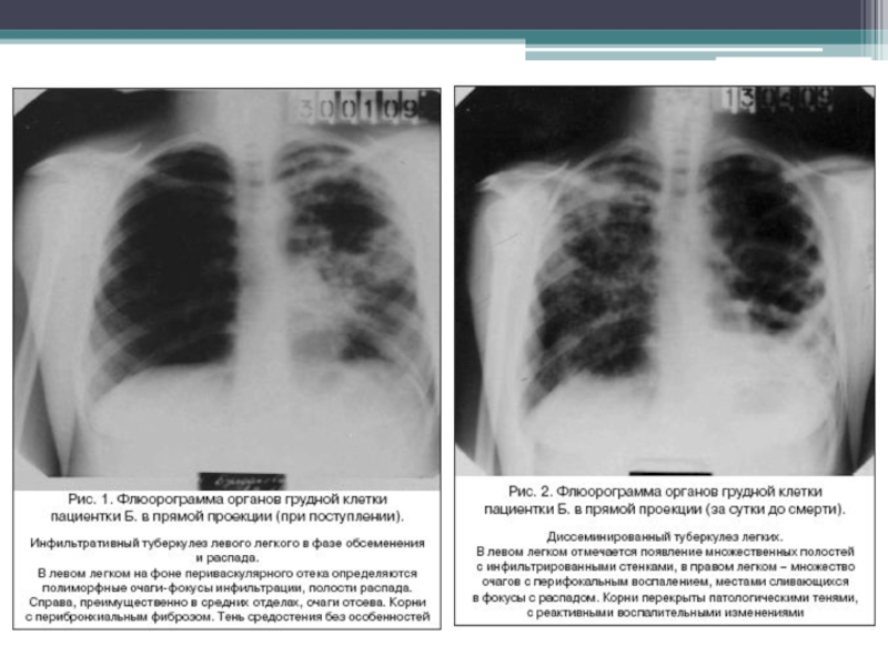 Диссеминированный туберкулез фаза инфильтрации. Кавернозный туберкулез верхней доли правого легкого в фазе. Фазы диссеминированного туберкулеза. Диссеминированный туберкулез в фазе распада. Фазы диссеминированного туберкулеза легких.